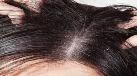 স্থায়ীভাবে খুশকি দূর করার উপায়