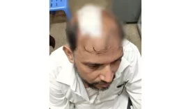 ছাদের পলেস্তারা পড়ে মাথা ফাটল দুদক কর্মকর্তার