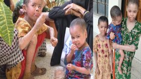 বরিশালে বিরল রোগে আক্রান্ত তিন বোন ‍॥ অসহায় মায়ের কান্না