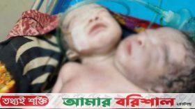 দুই মাথা ও এক দেহবিশিষ্ট বিরল শিশুর জন্ম